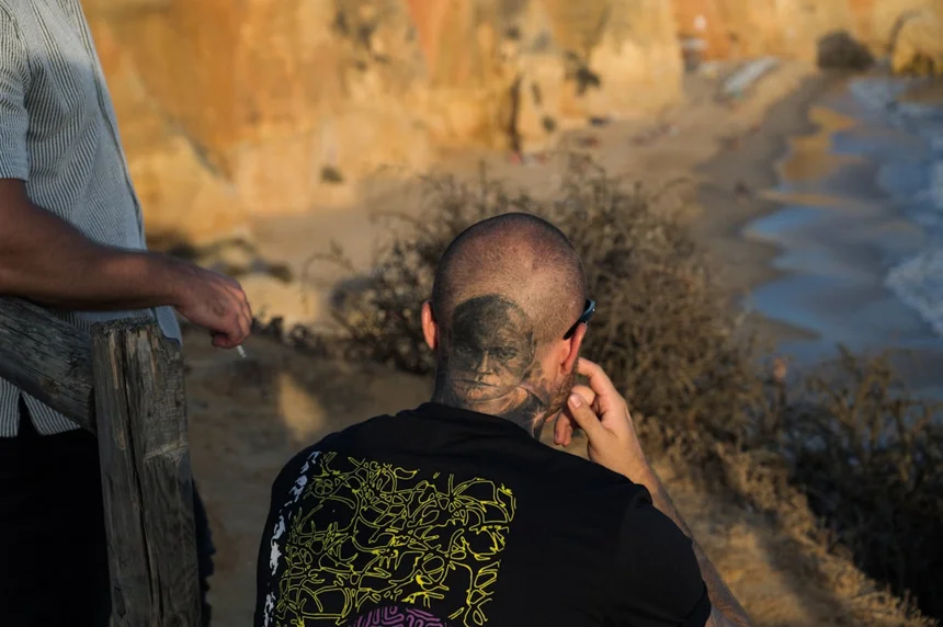 Alopecia