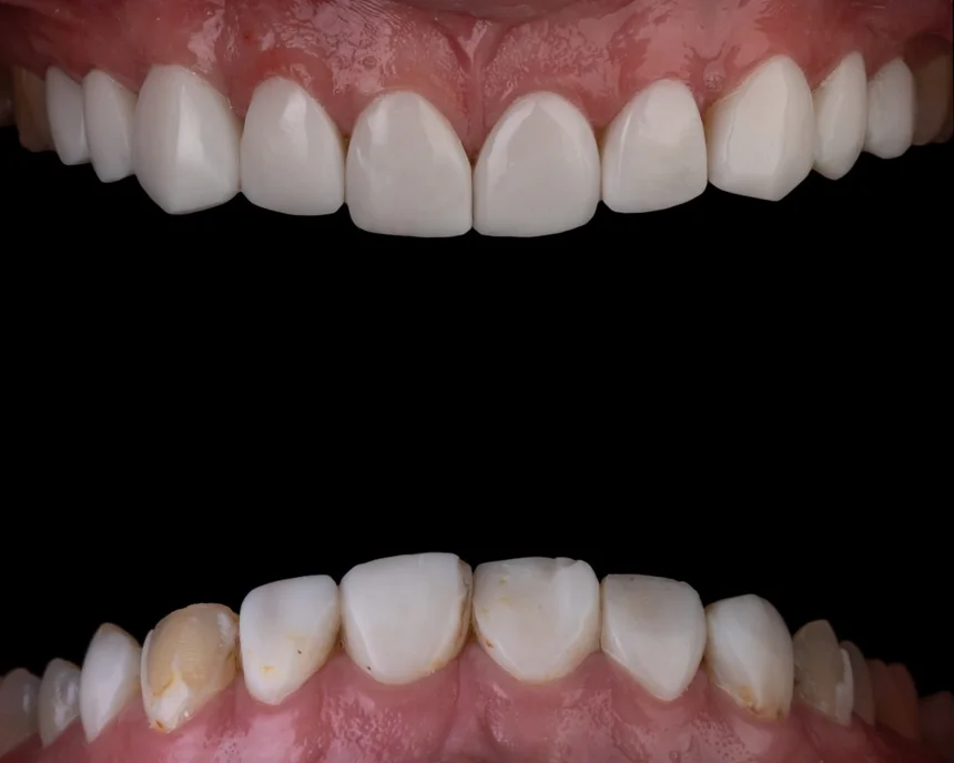 Tooth
